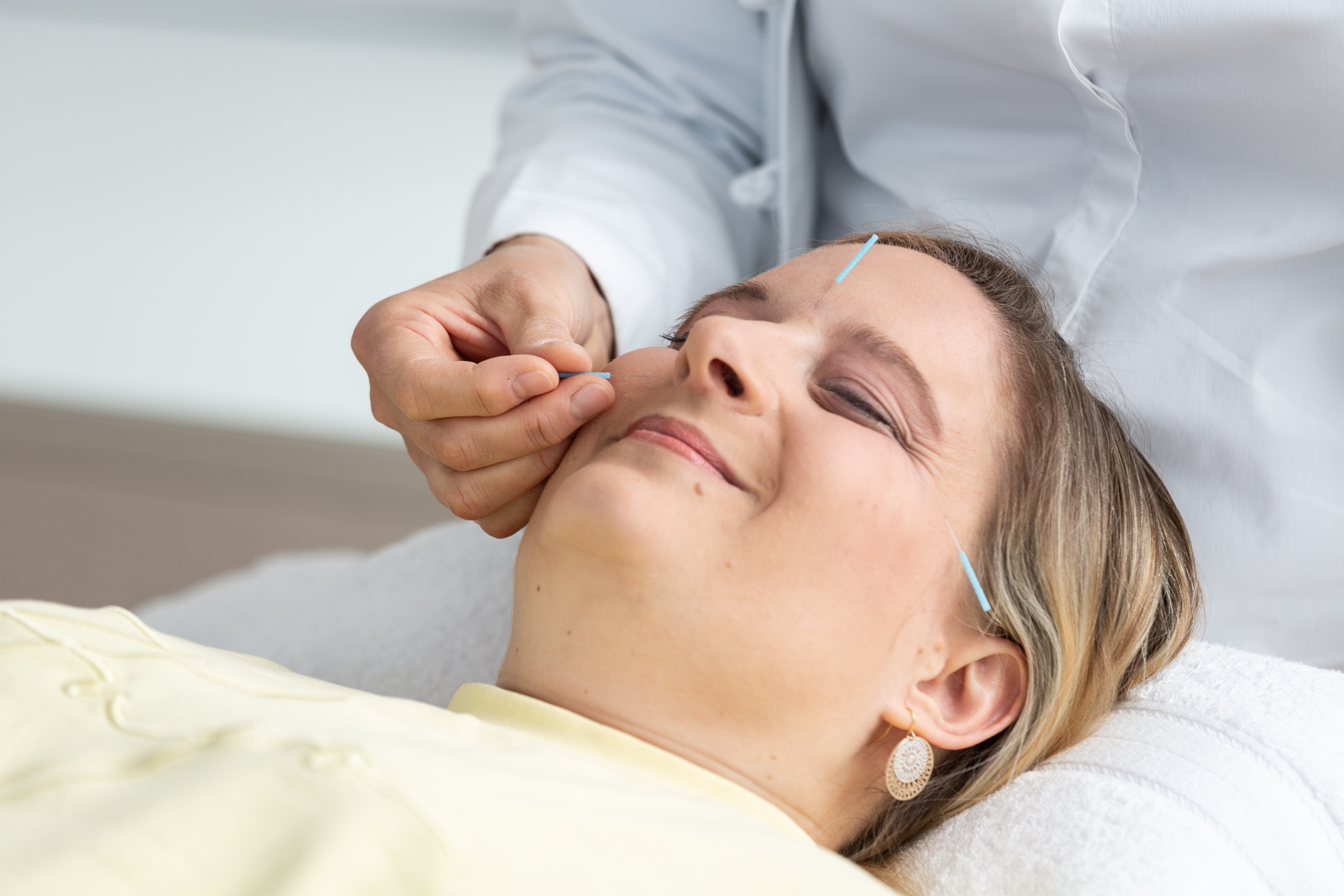 Eine Patientin erhält eine Akupunktur Behandlung im Gesicht